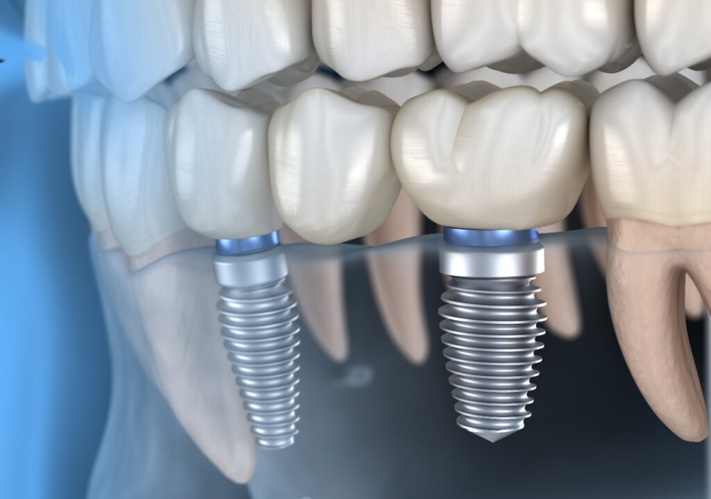 Clínica Para Implante Dentário Borba Odontologia em Copacabana