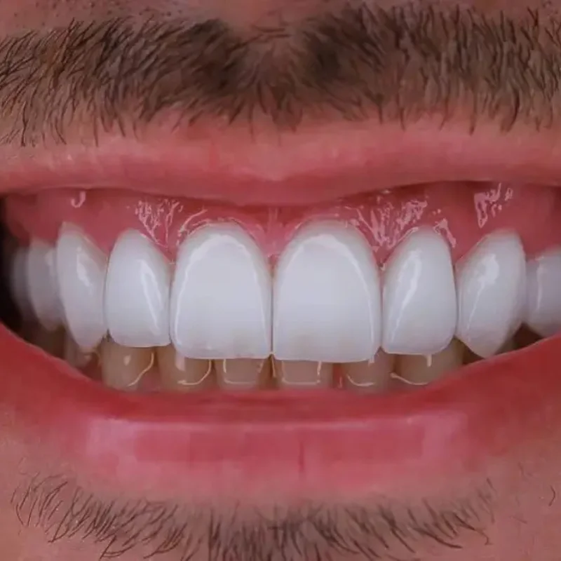 Facetas em porcelana Borba Copacabana