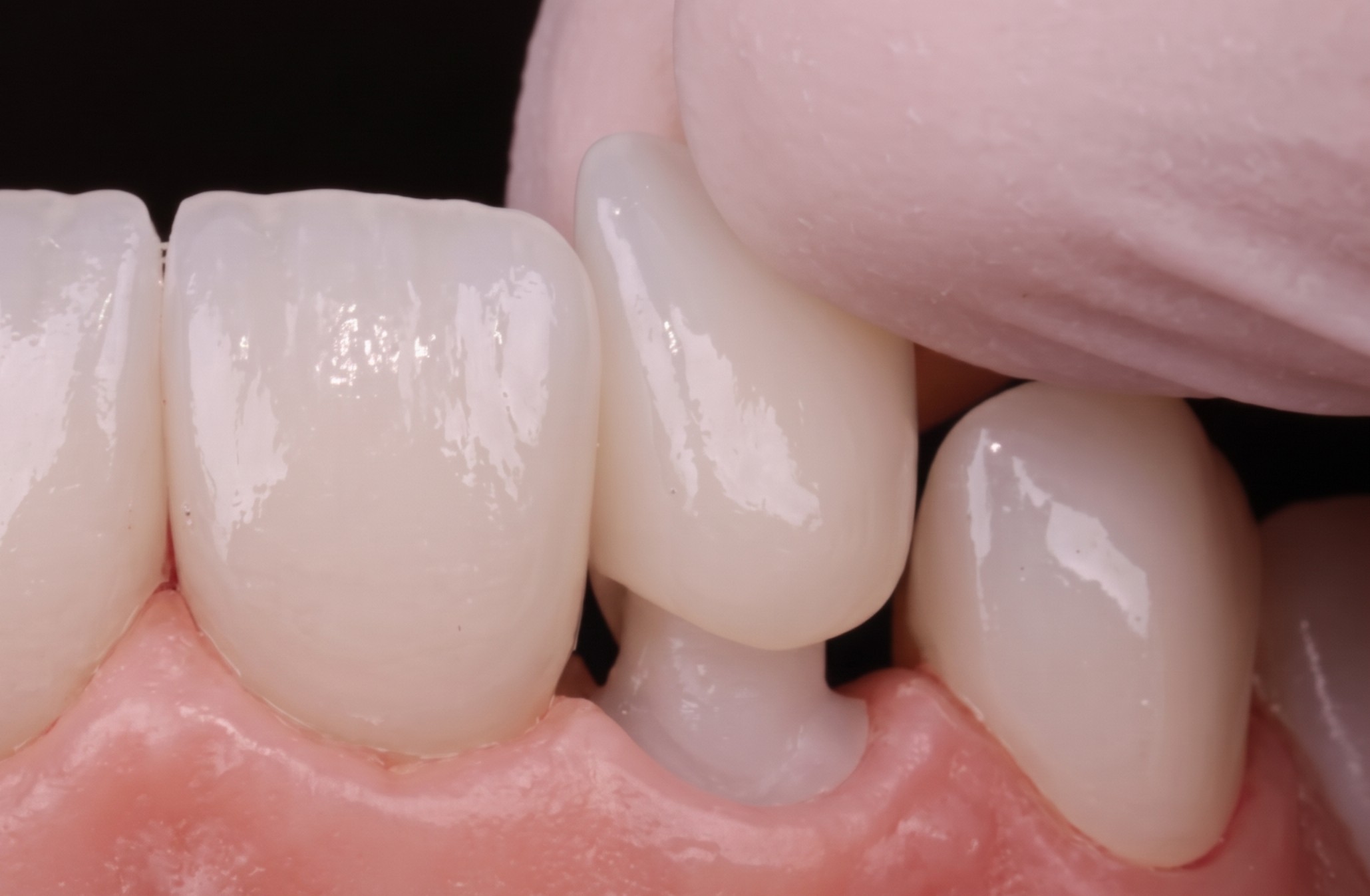 Coroas de Porceelana Borba Odontologia m Copacabana